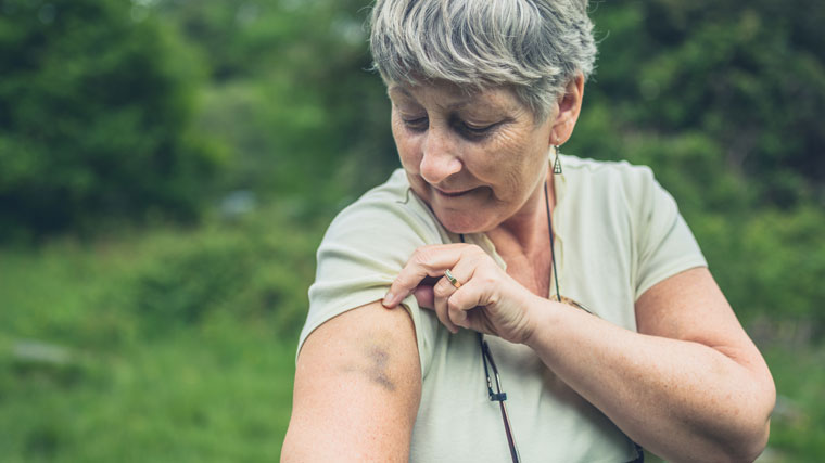 Easy Bruising Why It Happens When To Be Concerned Premier Health 5075