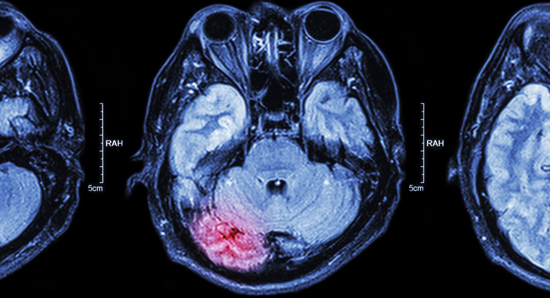 what-happens-during-a-stroke-premier-health